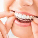 Aparat Invisalign Warszawa