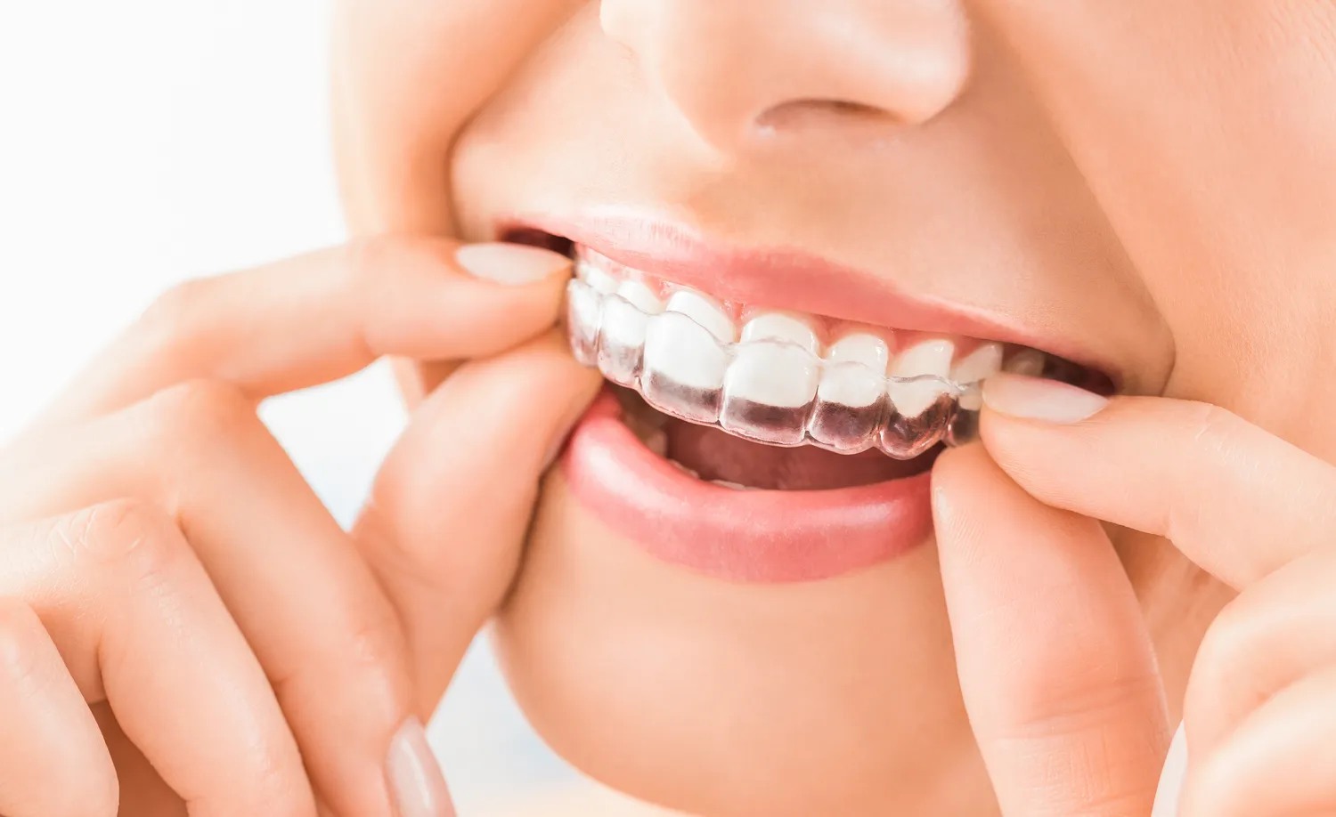 Aparat Invisalign Warszawa